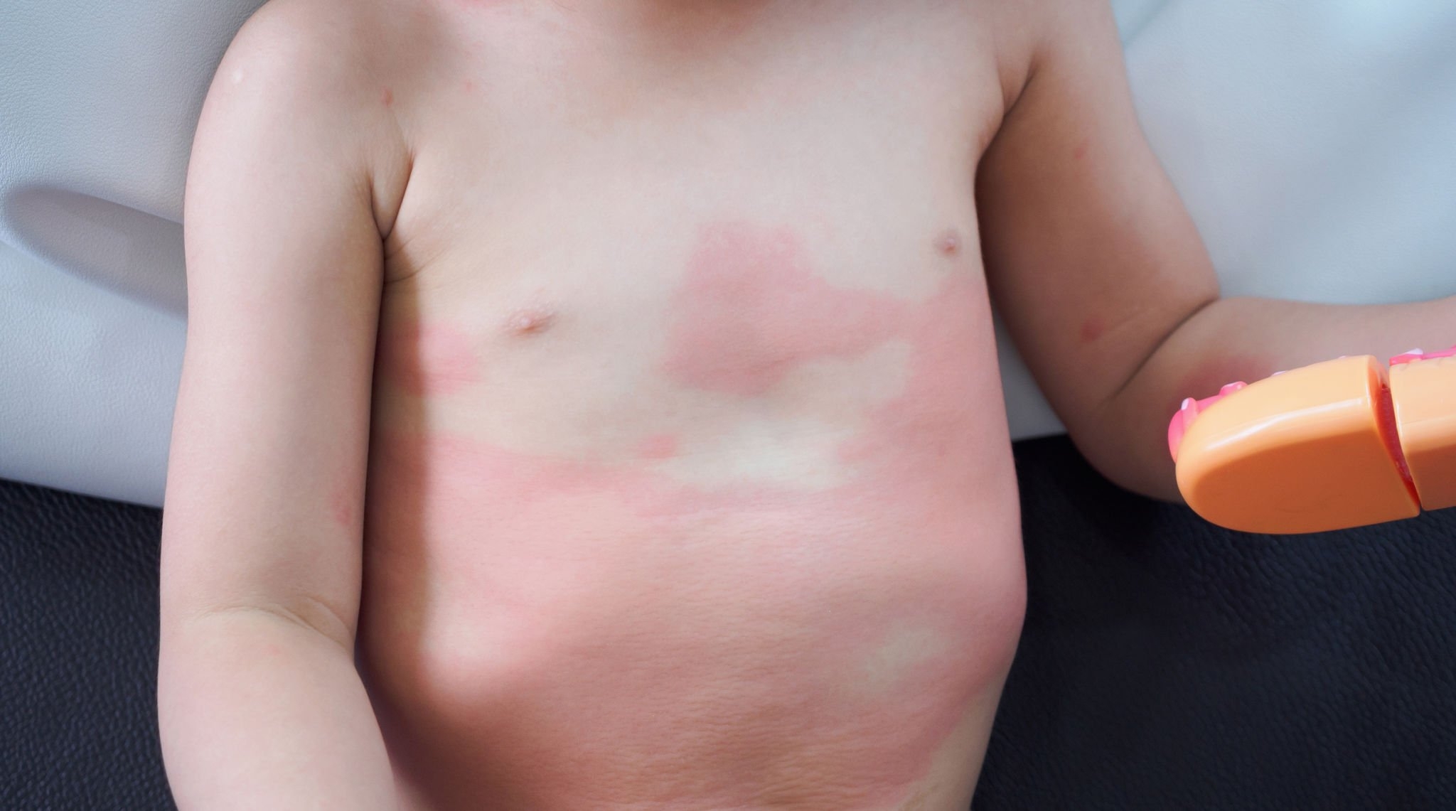 Cutaneous Fungal Infections in Children: A Common Concern and Effective Treatments